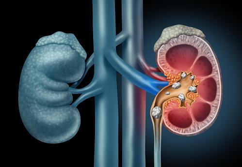 best kidney stone laser surgery